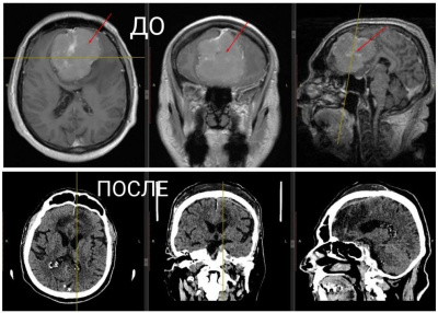 В Коломне мужчине удалили опухоль мозга размером с теннисный мяч