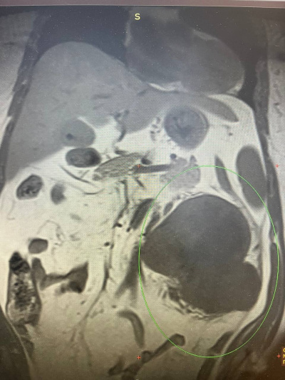 В Коломне женщине удалили трёхкилограммовую опухоль почки