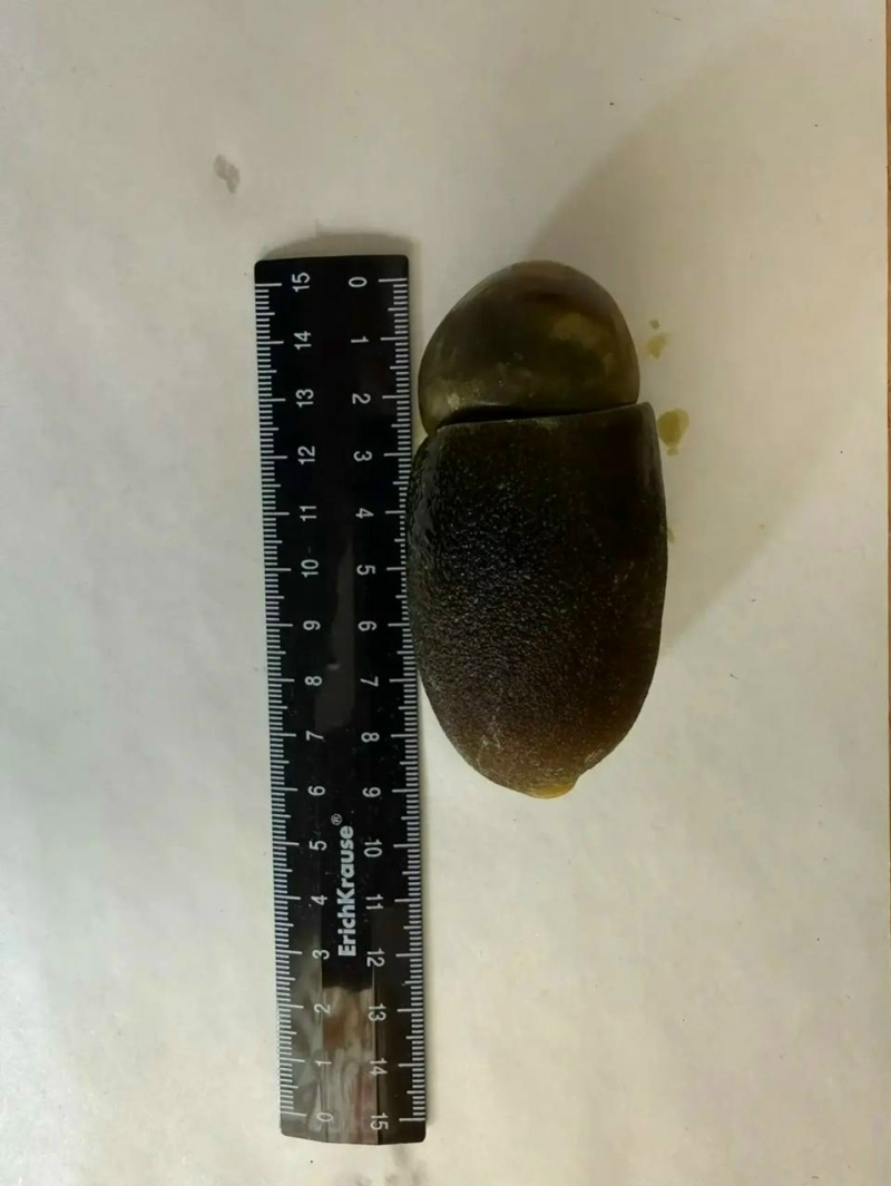 Коломенские хирурги извлекли два крупных камня из желчного пузыря пациентки