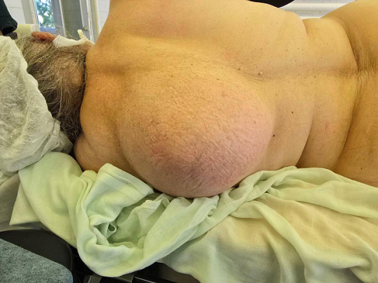 В Зарайске врачи успешно удалили женщине опухоль размером с футбольный мяч