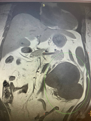 В Коломне женщине удалили трёхкилограммовую опухоль почки